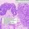 Transitional Cell Carcinoma Bladder