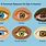 Types of Sore Eyes