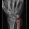 Ulnar Styloid Fracture Wrist