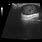 Ultrasound of Cyst