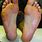 Vesicular Athlete's Foot