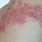 What Does Shingles Look Like Pictures