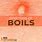 What Is a Boil