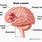 What Is a Brain Lesion