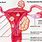 What Is a Fibroid Cyst in the Uterus