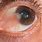 White Spot On Eye Pupil