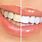 White Teeth Tips