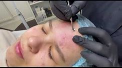 Professional face cleaning. Removal of pimples. Professionelle Gesichtsreinigung.