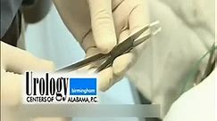 视频：男性输精管结扎术