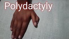 Polydactyly# Double Thumb