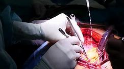 Coronary artery bypass graft surgery. CABG. 4K footage, Close-up