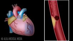 Myocardial Infarction and Coronary Angioplasty Treatment, Animation.
