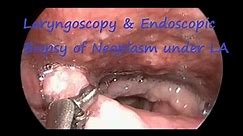 Laryngoscopy & Endoscopic Biopsy of Neoplasm under LA