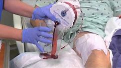 closed wound drainage system video
