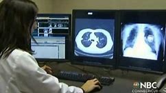 Using CT Scans to Screen for Lung Cancer