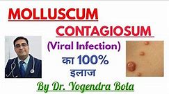 Molluscum Contagiosum ka 100% Treatment