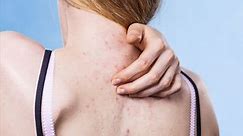 The 15 best products to get rid of back acne, according to dermatologists | CNN Underscored