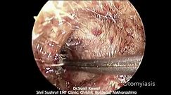 Otomyiasis | Maggots in Ear | Endoscopic Maggots Removal from ear