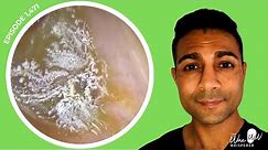 1,471 - Aural Polyp Behind Fungal Infected Debris | Was Community Ear Wax Removal Pilot a Success?