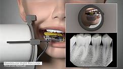 DEXIS™ Titanium by KaVo - Full Mouth Series Positioning Guide