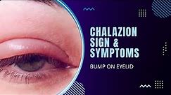 chalazion | eye stye | pimple on eyelid | eye stye causes | eye pimple causes & treatment