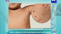 UNTV Life: What causes water warts in adults and kids?