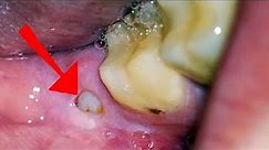 Wisdom Tooth Pain: What you NEED to Know (Oral Sedation, Home Remedies and What to Expect)