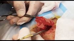 Deep Inside Crusader's Cyst! Big Cyst Removal