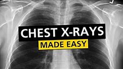 Chest X Rays (CXR) Made Easy! - Learn in 10 Minutes!