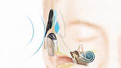 Discover Hearing Implants