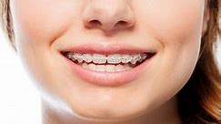 Clear Braces Cost: Guide to Invisible Braces and Clear Aligners in the UK