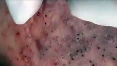 Satisfying viral acne Millions blackheads new 2021 #001