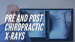Pre and Post X-rays Show Improvement With Chiropractic Care - Houston Chiropractor