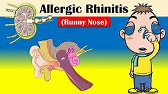 Allergic Rhinitis (Runny Nose) - Causes, Triggering Factors, Signs & Symptoms, And Treatment