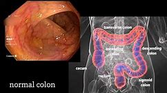 Colonoscopy: A Journey Though the Colon and Removal of Polyps