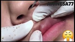MOST SATISFYING PIMPLE BLACKHEAD POPPING For 2020