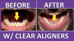 Invisalign Braces Before and After: Overbite, Crowding Teeth: Cost, Pain, Tips 3M Clear Aligners