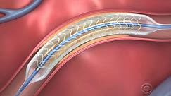 U.S. surgeons implant first dissolvable stent