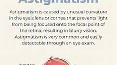 What is astigmatism? ​​Astigmatism is caused by unusual curvature in the eye’s lens or cornea that prevents light from being focused into the focal point of the retina. This results in blurry vision. Astigmatism is very common and easily detectable through an eye exam. Source: https://www.healthline.com/health/astigmatism#types | DePoe Eye Center