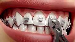 牙套女孩的新选择，用自锁托槽来矫正牙齿，避免被结扎丝刮的疼！