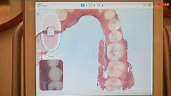 Orthodontic Records: Itero Scanning for Clear Aligner Orthodontic Treatment