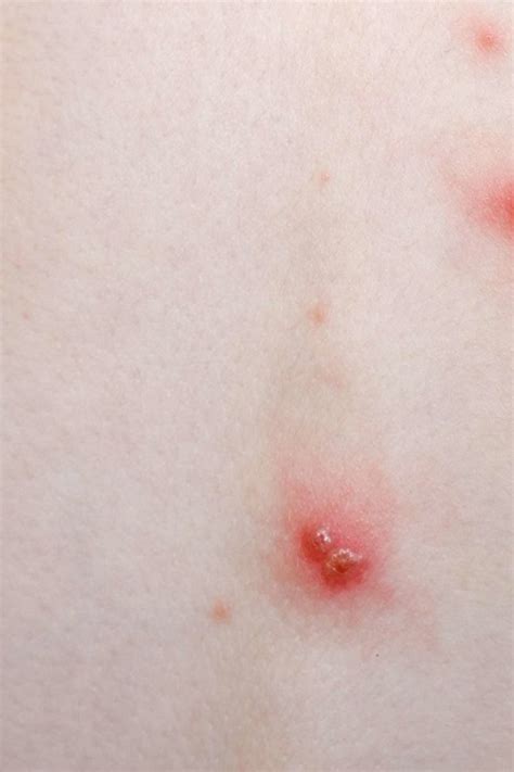 chickenpox symptoms treatment stages and causes