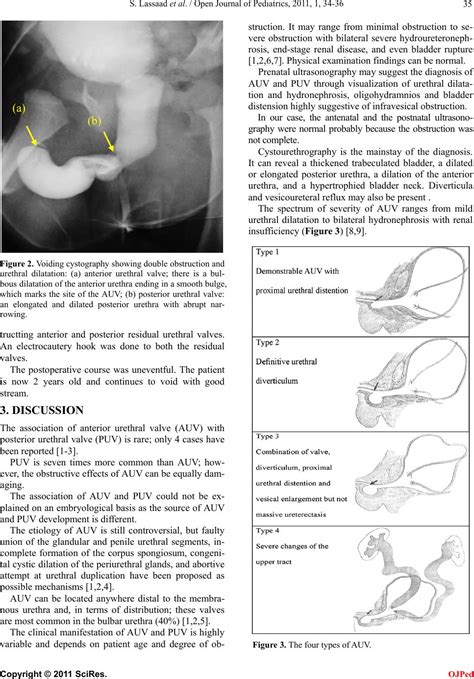 Anterior And Posterior Urethral Valves A Rare Association