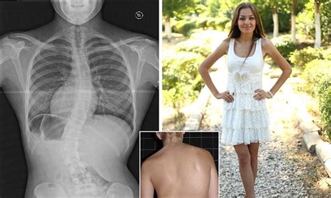 teenager overcomes spine condition scoliosis to become model daily