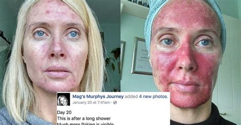 This Woman S Graphic Selfies Show Exactly The Danger Tanning Can Do To