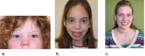 Variable Facial Features In Girls With Trisomy X A E Open I
