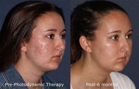 photodynamic therapy acne treatment san diego ca clderm