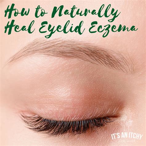 naturally heal eyelid eczema   itchy  world