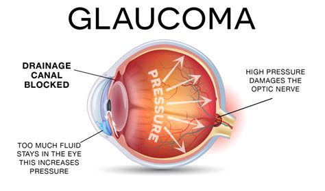 glaucoma treatment pgheyemeds