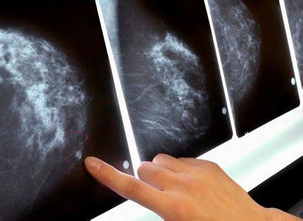 definisi stadium  penyebab kanker payudara kajianpustaka